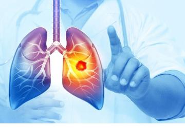 Her Yıl 25 Bin Akciğer Kanseri Vakası Önlenebilir